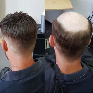 If you are a man who is experiencing hair loss